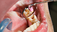 Things to Consider Before Getting a Root Canal Treatment