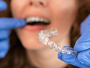 What Foods Should I Avoid During Invisalign Treatment?