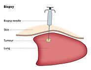 What Is a Biopsy?