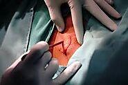 Surgical Biopsy