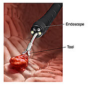 Endoscopic Biopsy