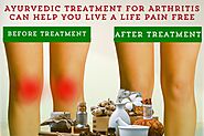 Ayurvedic Treatment for Arthritis can Help you Live a Life Pain Free