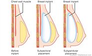 Breast Augmentation