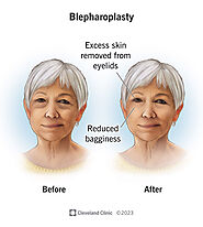 Blepharoplasty (Eyelid Surgery)