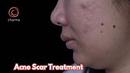 Acne Scar Treatment in Bangalore