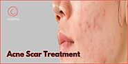 Acne Scar Treatment In Bangalore