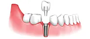 Dental Implants in Barrie, ON | Affordable Teeth Implant Clinic