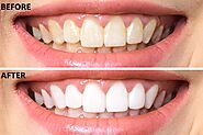 Teeth Whitening in Barrie, ON | Fast & Affordable Results