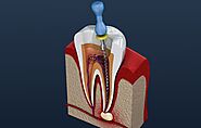 Root Canals in Barrie | Restore Your Smile With Root Canal Expert