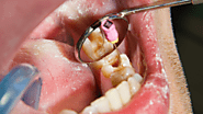 What to Expect During Your Root Canal Treatment?