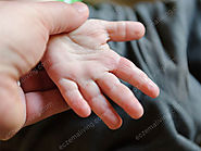 How To Treat Hand Eczema in Babies - Eczema On Hands