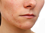 How to Treat Eczema on Face? - Facial Eczema Tips - Eczema Living