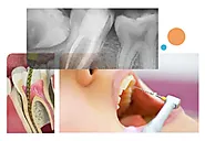 Root Canal Treatment Gurgaon