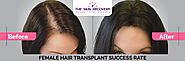 Female Hair Transplant Success Rate