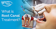 Root Canal Treatment