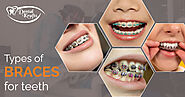 Teeth Braces Types