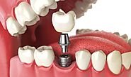 Dental Implants Tulsa, OK | Perfect Smile Tulsa | Dental Implants Near Me