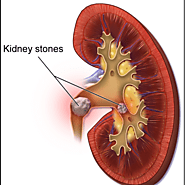 Kidney Stone Treatment in Chennai | Best Kidney Stone Treatment in Chennai | Complete Urology