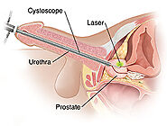 Laser Treatment in Chennai | Laser Prostatectomy in Chennai | Complete Urology