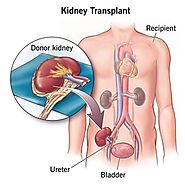 Kidney Transplant in Chennai | Kidney Replacement in Chennai | Complete Urology