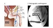 Urine blockage treatment in chennai | Urine Management in Chennai | Complete Urology