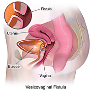 Urinary Leak Treatment in Chennai | Fistula Surgery in Chennai | Complete Urology