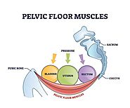 How Do You Fix a Hypertonic Pelvic Floor?