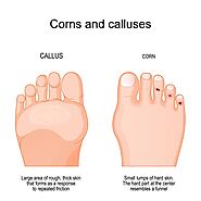 Blog 71 – Is Foot Corn Removal Painful? Non-Invasive & Lasting Treatments