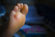 Blog 73 - Foot Corn Treatment: How Does a Podiatrist Safely Remove Them (and Calluses)?