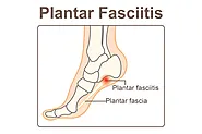 Blog 74 - What Is Plantar Fasciitis? Do I Have It? What Can I Do About It? | Plantar Health