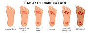 Blog 75 - What are the five stages of a diabetic foot ulcer? When Should I Seek Professional Help?