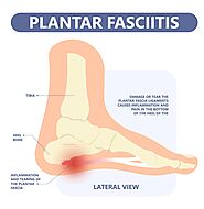 Plantar Fasciitis: What You Need To Know About Symptoms, Causes And Podiatry Treatments