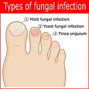 Toenail Fungus Treatment & Lasting Antifungal Remedies