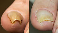 Onyfix: Painless treatment for ingrown toenails