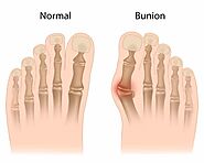 Bunion Self-Care: How to Treat Bunions at Home Effectively | Foot Health Avoid Toe Pain Podiatrist Exercises