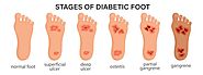 Diabetic Foot Problems: Symptoms, Podiatry Treatment, and Care