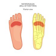 Blog 61 - What Do Podiatrists Do for Metatarsalgia?