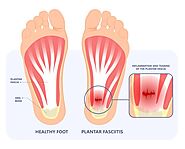 Blog 66 – How Do I Fix My Heel Pain? Home Remedies and Lasting Podiatry Treatments