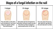 Blog 67 - What Nail Fungus Cure Works Best on My Fungal Toenail? | Toenail Infection Health Education