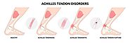 Achilles Tendonitis: Symptoms, Causes, and Podiatry Treatments | Achilles Tendinitis Heel Pain Clinic