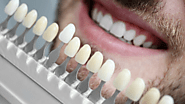 Exploring The Different Types of Dental Veneers?