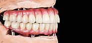 Common Myths and Facts About Denture Implants