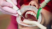 The Role of Professional Teeth Cleaning in Preventing Cavities