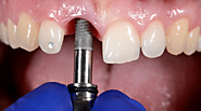 Why Dental Implants Are the Best Solution for Missing Teeth