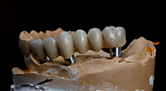 Understanding the Different Types of Dental Bridges: Which One Suits You Best?