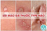 Bạn có gặp rắc rối không biết sùi mào gà thuộc type nào?