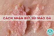 Hướng dẫn cách nhận biết sùi mào gà ở nam và nữ đúng cách