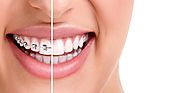 How much do Adult Braces Cost ? | Smilesbylyles