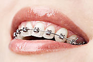 Find Orthodontist | Helpful Site on Orthodontics | Smilesbylyles.com