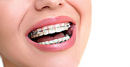 Damon Smile-Benefits of Damon Braces for Oral Health